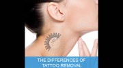 Laser Tattoo Removal Brisbane
