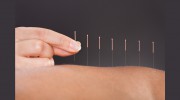 NM Acupuncture
