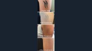 Rethink Laser Tattoo Removal