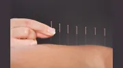 NM Acupuncture