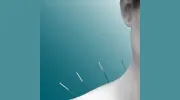 Peel Acupuncture